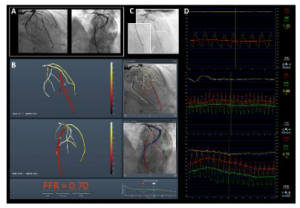 CathWorks FFRangio System delivers objective measurements to confirm PCI decisions.
